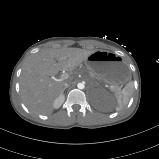 Abdominal multi-trauma - devascularised kidney and liver, spleen and pancreatic lacerations (Radiopaedia 34984-36486 Axial C+ arterial phase 90).png
