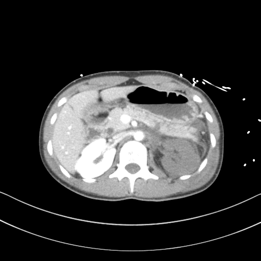 Abdominal multi-trauma - devascularised kidney and liver, spleen and pancreatic lacerations (Radiopaedia 34984-36486 Axial C+ portal venous phase 28).png