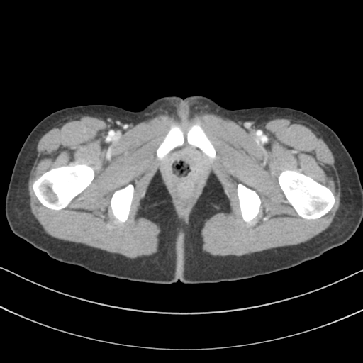 File:Abdominal multi-trauma - devascularised kidney and liver, spleen and pancreatic lacerations (Radiopaedia 34984-36486 Axial C+ portal venous phase 86).png