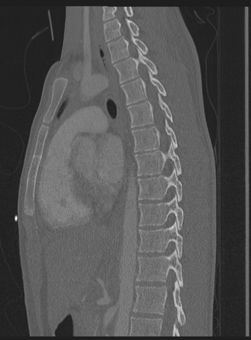 Abdominal multi-trauma - devascularised kidney and liver, spleen and pancreatic lacerations (Radiopaedia 34984-36486 Sagittal bone window 28).png