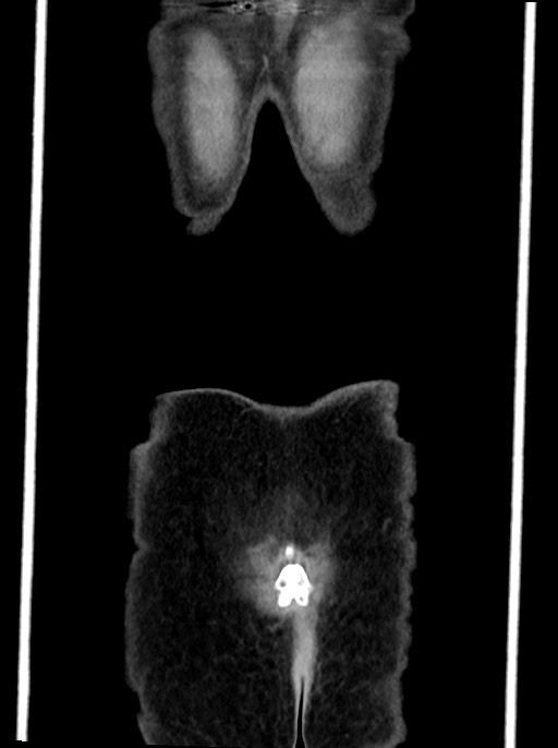 Abdominal wall and retroperitoneal tuberculosis (Radiopaedia 88137-104729 Coronal C+ portal venous phase 103).jpg