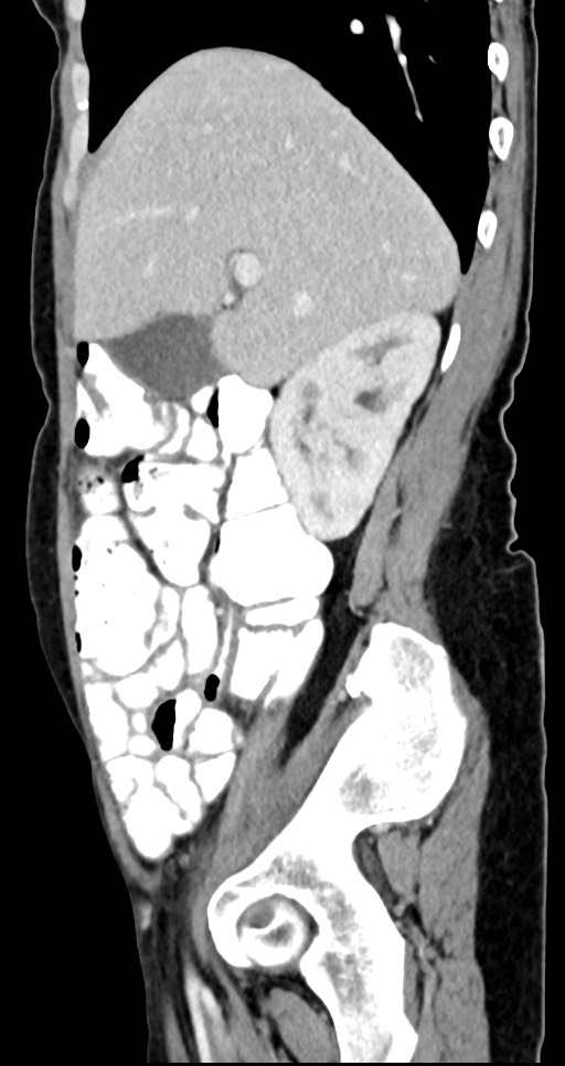 Abdominal wall and retroperitoneal tuberculosis (Radiopaedia 88137-104729 Sagittal C+ portal venous phase 106).jpg