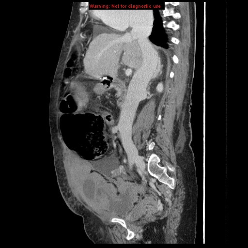 Abdominal wall hematoma (Radiopaedia 9427-10112 Sagittal C+ portal venous phase 63).jpg