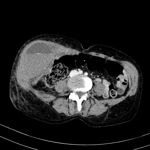 Abdominal wall hematoma with active bleeding (Radiopaedia 83915-99122 Axial contrast-enhanced CT 42).jpg