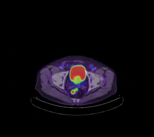 Abdominal wall metastasis from colorectal carcinoma (Radiopaedia 31016-31719 Axial 27).jpg