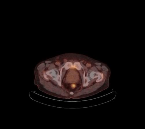 Abdominal wall metastasis from colorectal carcinoma (Radiopaedia 31016-31719 C 23).jpg