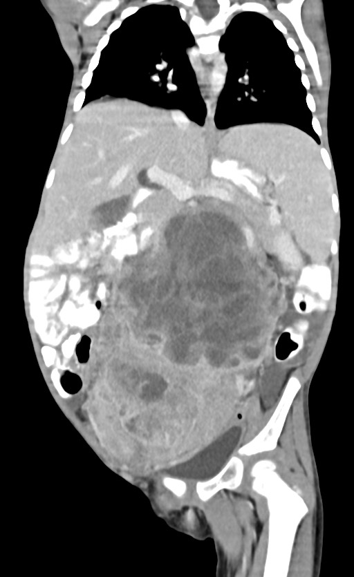 Abdominopelvic rhabdomyosarcoma (Radiopaedia 78356-90984 Coronal C+ portal venous phase 51).jpg