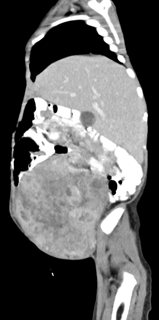 Abdominopelvic rhabdomyosarcoma (Radiopaedia 78356-90984 Sagittal C+ portal venous phase 77).jpg