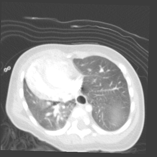 File:Aberrant left pulmonary artery (pulmonary sling) (Radiopaedia 42323-45435 Axial lung window 26).jpg