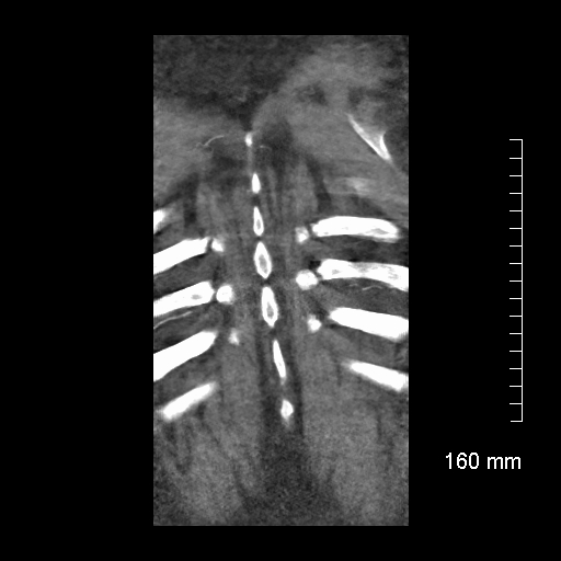 Aberrant right subclavian artery stenosis (Radiopaedia 52656-58670 B 78).jpg