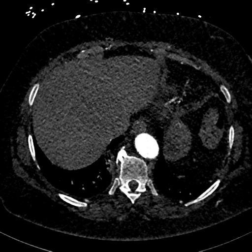 File:Aberrant right subclavian artery with Kommerell diverticulum (Radiopaedia 47982-52769 Axial C+ arterial phase 81).png