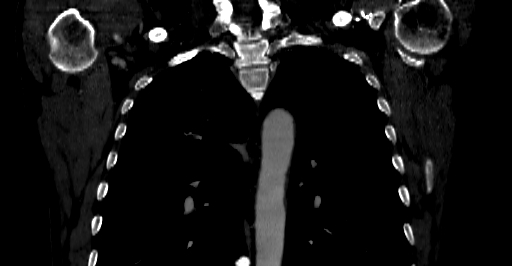 Accesory rib joint (Radiopaedia 71987-82452 Coronal bone window 11).jpg