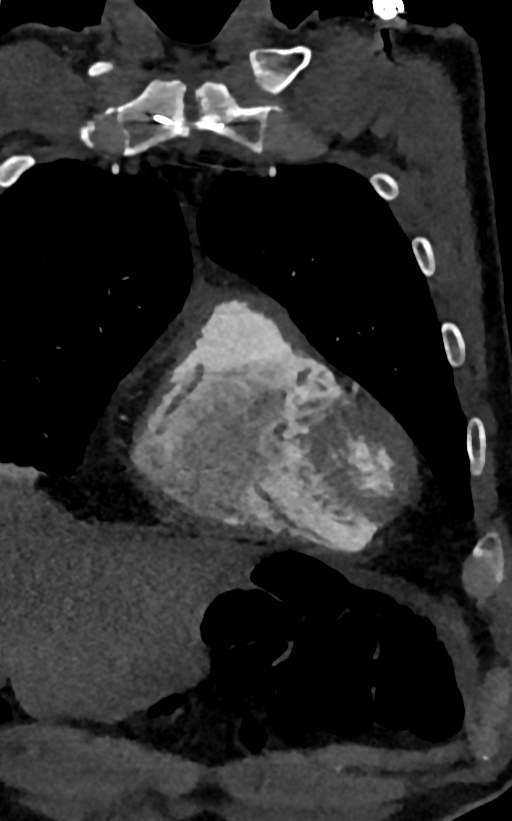 Accessory left atrial appendage (Radiopaedia 81987-95968 Coronal C+ arterial phase 10).jpg