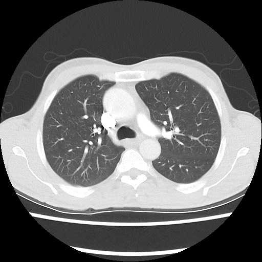 Accessory left horizontal fissure with lingular pneumonia (Radiopaedia 53763-59843 Axial lung window 22).jpg