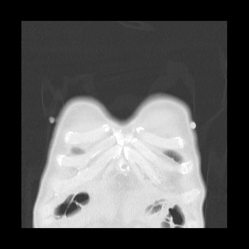 Accessory left horizontal fissure with lingular pneumonia (Radiopaedia 53763-59843 Coronal lung window 5).jpg