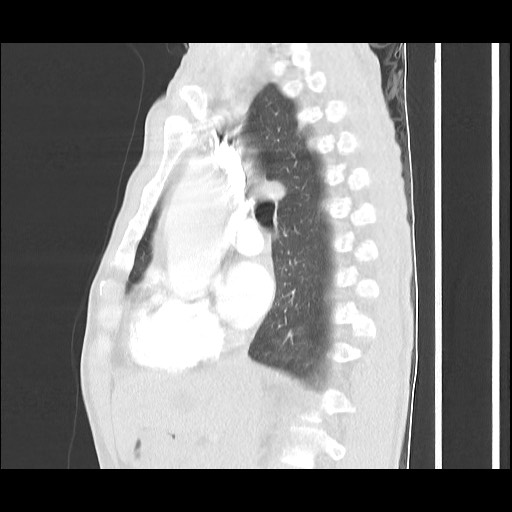 Accessory left horizontal fissure with lingular pneumonia (Radiopaedia 53763-59843 Sagittal lung window 32).jpg