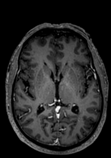 Accessory middle cerebral artery (Radiopaedia 73114-83828 Axial T1 C+ 28).jpg