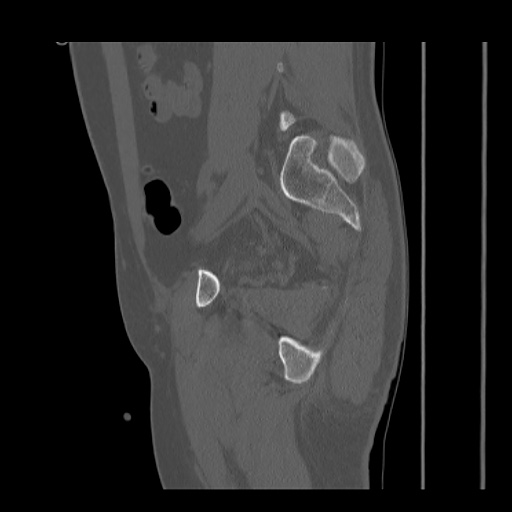 File:Acetabular and ilial fractures (Radiopaedia 59084-66378 Sagittal bone window 65).jpg