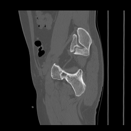 Acetabular and ilial fractures (Radiopaedia 59084-66378 Sagittal bone window 68).jpg