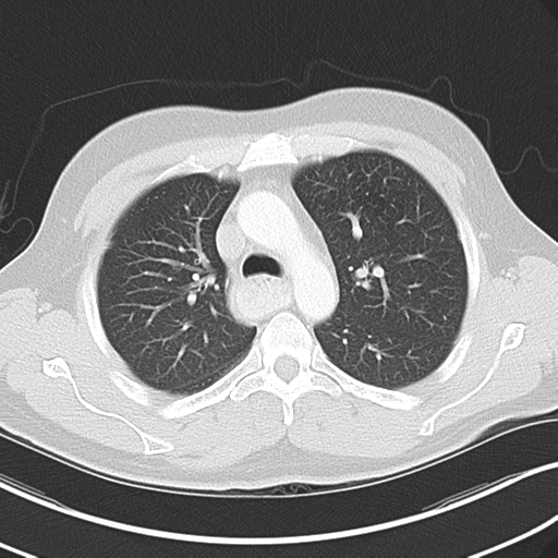 Achalasia of the cardia (Radiopaedia 38497-40595 Axial lung window 18).png