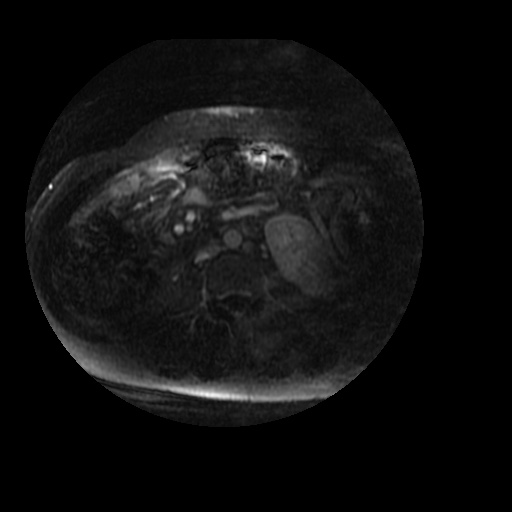 Acinar cell carcinoma of the pancreas (Radiopaedia 75442-86668 Axial T1 C+ fat sat 3).jpg