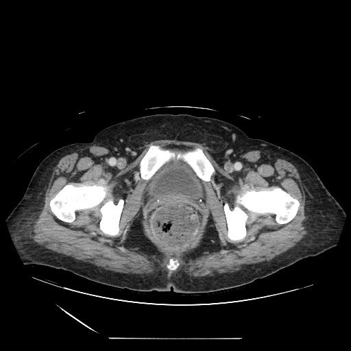 Acinar cell carcinoma of the pancreas (Radiopaedia 75442-86669 Axial C+ portal venous phase 145).jpg