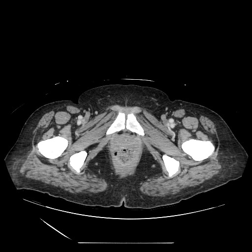 Acinar cell carcinoma of the pancreas (Radiopaedia 75442-86669 Axial C+ portal venous phase 151).jpg