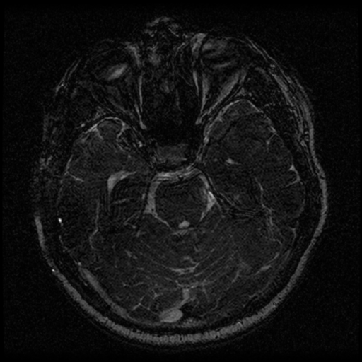Acoustic schwannoma (Radiopaedia 33045-34060 Axial T2 64).png