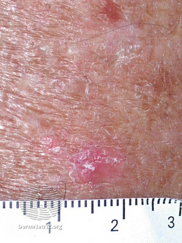 File:Actinic Keratoses affecting the legs and feet (DermNet NZ lesions-ak-legs-499).jpg