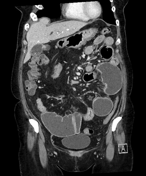 Active Crohn disease (Radiopaedia 59394-66750 Coronal C+ portal venous phase 27).jpg