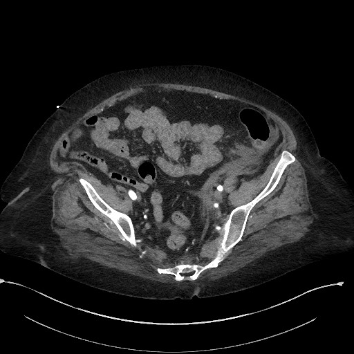 File:Active renal extravasation with large subcapsular and retroperitoneal hemorrhage (Radiopaedia 60975-68796 Axial C+ arterial phase 154).jpg