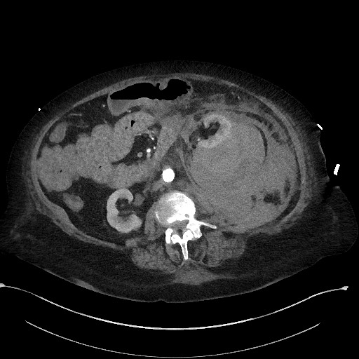 Active renal extravasation with large subcapsular and retroperitoneal hemorrhage (Radiopaedia 60975-68796 Axial C+ arterial phase 91).jpg