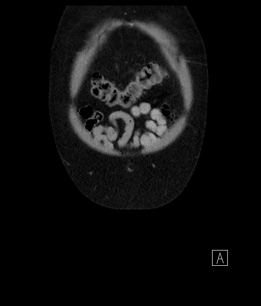 Acute-on-chronic pancreatitis (Radiopaedia 67286-76656 Coronal C+ portal venous phase 12).jpg