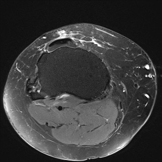 File:Acute-on-chronic transient lateral patellar dislocation with trochlear dysplasia (Radiopaedia 84099-99349 Axial PD fat sat 29).jpg