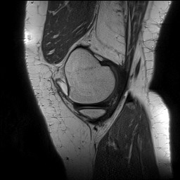 Acute-on-chronic transient lateral patellar dislocation with trochlear dysplasia (Radiopaedia 84099-99349 Sagittal PD 39).jpg