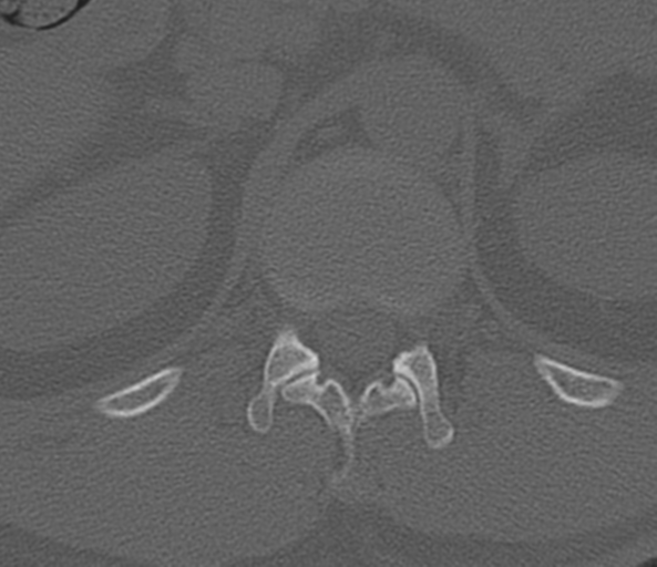 File:Acute L1 burst compression fracture (Radiopaedia 34430-35755 Axial bone window 6).png