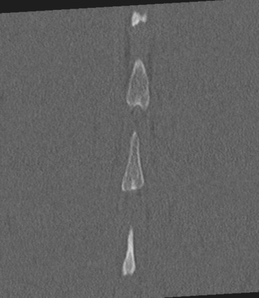 Acute L1 burst compression fracture (Radiopaedia 34430-35755 Coronal bone window 60).png