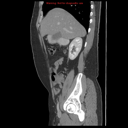 File:Acute appendicitis (Radiopaedia 10498-10973 Sagittal C+ portal venous phase 4).jpg