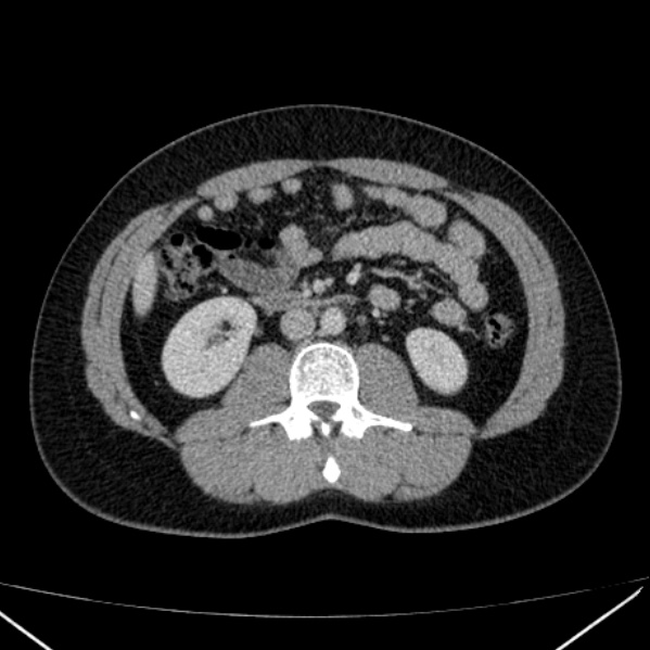 File:Acute appendicitis (Radiopaedia 38255-40270 Axial C+ portal venous phase 50).jpg
