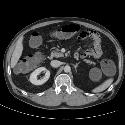 File:Acute appendicitis (Radiopaedia 66513-75790 Axial C+ portal venous phase 21).jpg