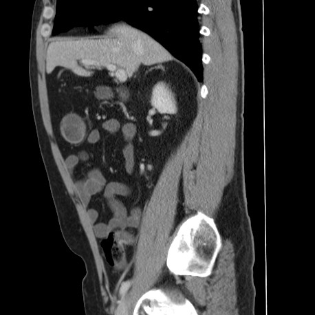 File:Acute appendicitis (Radiopaedia 66513-75790 Sagittal C+ portal venous phase 57).jpg
