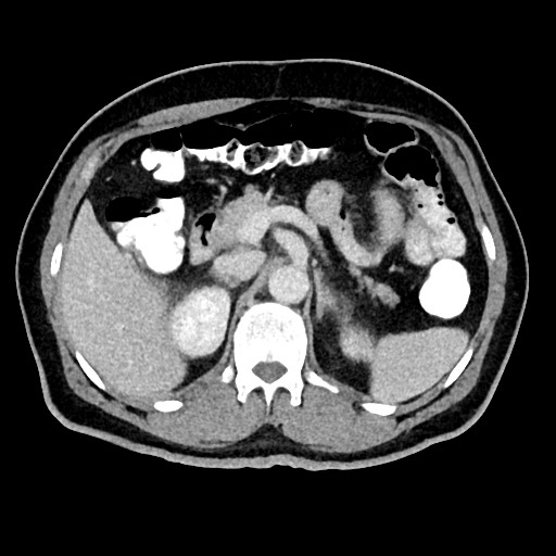 File:Acute appendicitis (Radiopaedia 77016-88960 Axial C+ portal venous phase 47).jpg