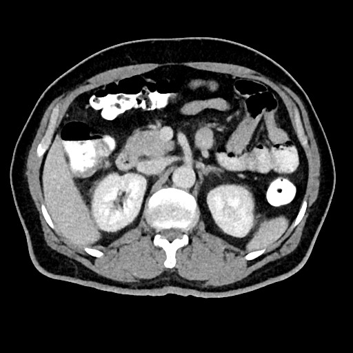 Acute appendicitis (Radiopaedia 77016-88960 Axial C+ portal venous phase 52).jpg