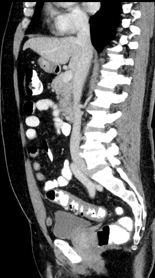 Acute appendicitis (Radiopaedia 77016-88960 Sagittal C+ portal venous phase 64).jpg
