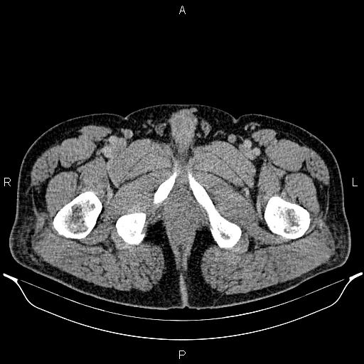 Acute appendicitis (Radiopaedia 84780-100240 Axial C+ portal venous phase 118).jpg