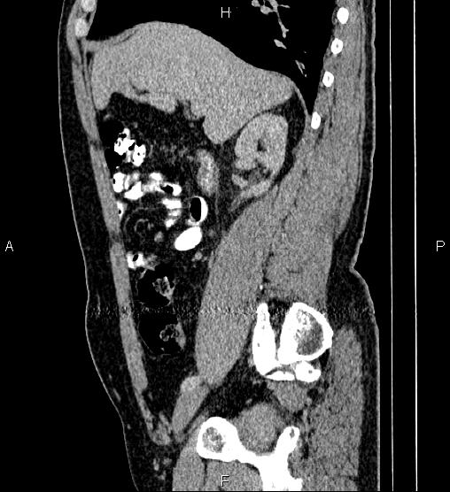 Acute appendicitis (Radiopaedia 84780-100240 Sagittal C+ portal venous phase 35).jpg