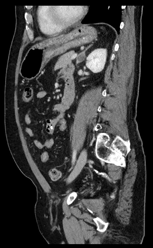 Acute appendicitis - large appendicoliths (Radiopaedia 61805-69820 Sagittal C+ portal venous phase 43).jpg