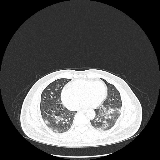 Acute appendicitis and COVID 19 pneumonia (Radiopaedia 76604-88380 Axial lung window 36).jpg