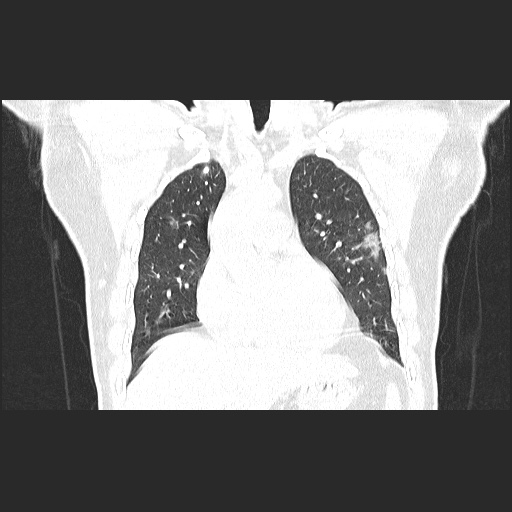 Acute appendicitis and COVID 19 pneumonia (Radiopaedia 76604-88380 G 24).jpg