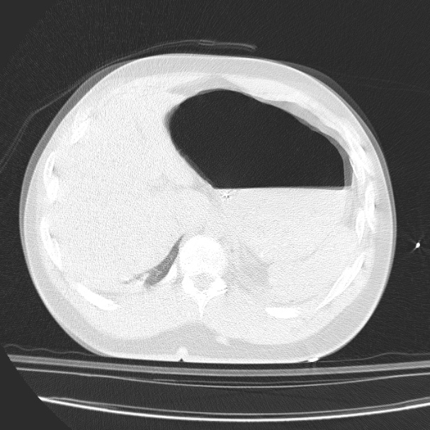 Acute aspiration pneumonitis (Radiopaedia 33605-34703 Axial lung window 92).jpg
